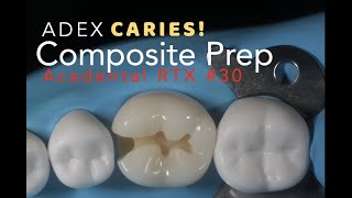 Class II Composite Preparation for ADEX Caries 30 MO [upl. by Zoara]