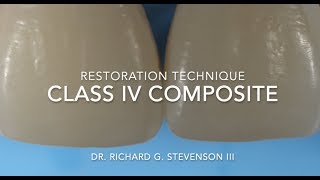 Class IV Composite Restoration  Restoration Technique [upl. by Nageam]