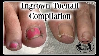 Satisfying Ingrown Toenail Pedicure Compilation [upl. by Katt84]