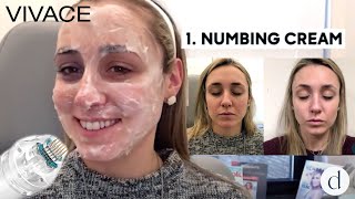 Vivace RF Microneedling  Patient Review [upl. by Acire501]