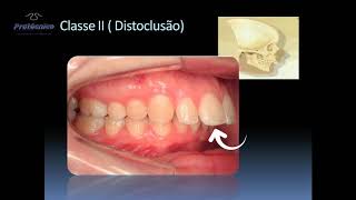 5 Classificação das maloclusões [upl. by Dela]