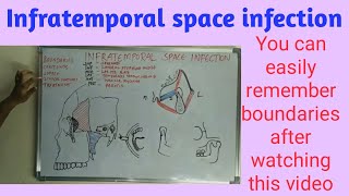 Infratemporal space infection [upl. by Kele455]