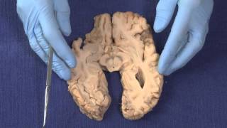 Basal Ganglia Neuroanatomy Video Lab  Brain Dissections [upl. by Latsirk799]