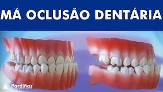 Má oclusão dentária  Classificação das maloclusões © [upl. by Ataymik]