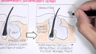 Acne Pathophsyiology [upl. by Ken212]