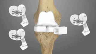 iTotal CR Total Knee Replacement Surgical Technique Animation  Conformis [upl. by Namyh]