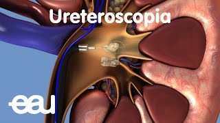 Tratamiento de cálculos renales y ureterales URS [upl. by Nedia652]