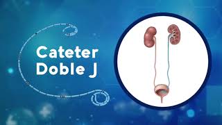 ¿Sabe es qué consiste una ureterolitotomía endoscópica ¡Calculaser SA le explica [upl. by Delmor282]