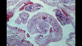 Schistosomiasis  Pathology mini tutorial [upl. by Haikezeh]