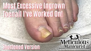 Most Extreme Ingrown Toenail Salon Pedicure  Shortened [upl. by Adnor]