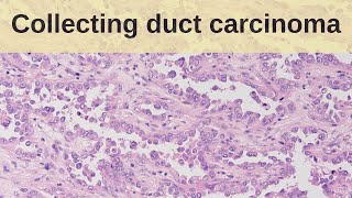 Collecting Duct Carcinoma  Pathology mini tutorial [upl. by Ferrick]