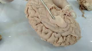 Basal Ganglia of Brain  Neuroanatomy [upl. by Marielle372]