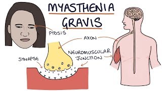 Myasthenia Gravis [upl. by Ayekat]