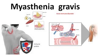 Neurology  Topic 20  Myasthenia gravis and Ptosis [upl. by Ahsinuq40]