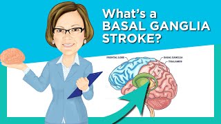 Basal Ganglia Stroke [upl. by Berti]