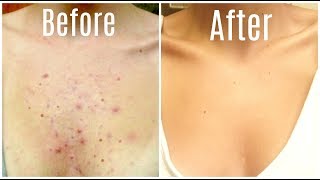 How I Got Rid Of My Body Acne FOREVER [upl. by Earas]